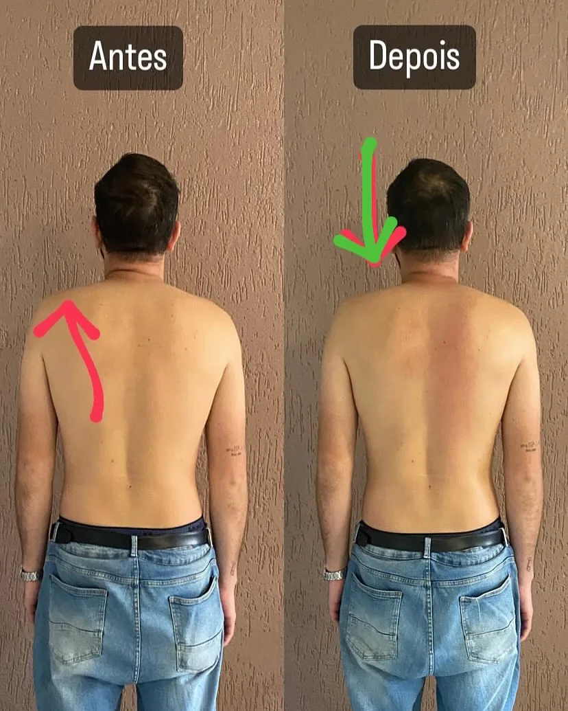 Costas de paciente com ombro elevado, antes e depois do atendimento