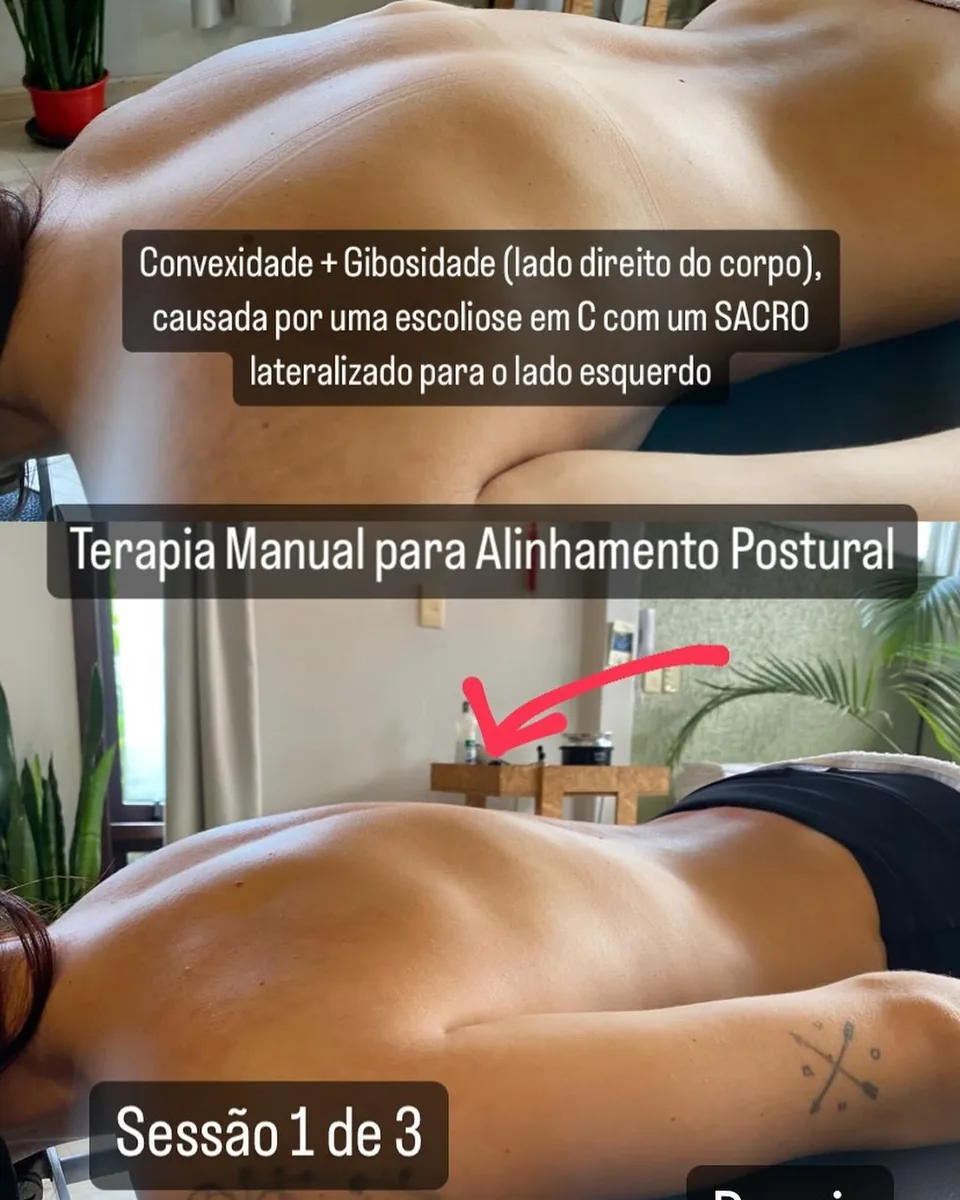Costas de paciente com escoliose em C, antes e depois da primeira sessão